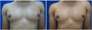 DH-gynecomastia-surgery-nyc-before-after-photo-1-1