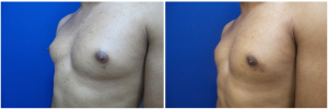 DH-gynecomastia-surgery-nyc-before-after-photo-1-3