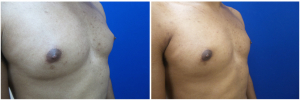 DH-gynecomastia-surgery-nyc-before-after-photo-1-4