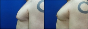 DS-gynecomastia-surgery-nyc-before-after-4-1