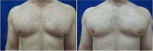 DS-gynecomastia-surgery-nyc-before-after-4-2