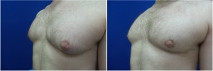 DS-gynecomastia-surgery-nyc-before-after-4-3