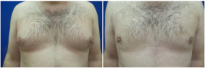 DS-gynecomastia-surgery-nyc-before-after-photo-1-1