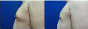 DS-gynecomastia-surgery-nyc-before-after-photo-1-2