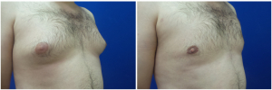 DS-gynecomastia-surgery-nyc-before-after-photo-1-3