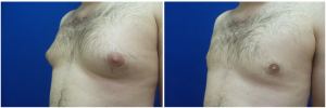 DS-gynecomastia-surgery-nyc-before-after-photo-1-4