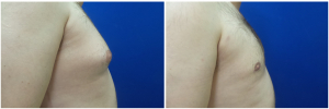 DS-gynecomastia-surgery-nyc-before-after-photo-1-5