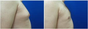 DS-gynecomastia-surgery-nyc-before-after-photo-1-5