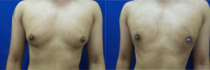 DS-gynecomastia-surgery-nyc-before-after-photo-10-1