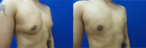 DS-gynecomastia-surgery-nyc-before-after-photo-10-2