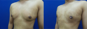 DS-gynecomastia-surgery-nyc-before-after-photo-10-4