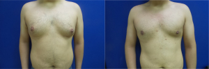 DS-gynecomastia-surgery-nyc-before-after-photo-11-1