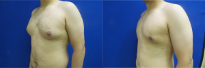 DS-gynecomastia-surgery-nyc-before-after-photo-11-2