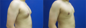 DS-gynecomastia-surgery-nyc-before-after-photo-11-3