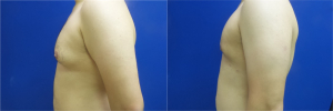 DS-gynecomastia-surgery-nyc-before-after-photo-11-4