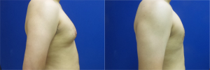 DS-gynecomastia-surgery-nyc-before-after-photo-11-5