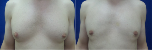 DS-gynecomastia-surgery-nyc-before-after-photo-12-1