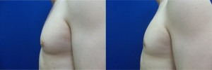 DS-gynecomastia-surgery-nyc-before-after-photo-12-2