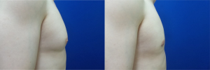 DS-gynecomastia-surgery-nyc-before-after-photo-12-3