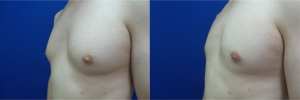 DS-gynecomastia-surgery-nyc-before-after-photo-12-4