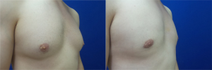 DS-gynecomastia-surgery-nyc-before-after-photo-12-5