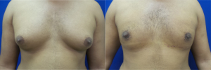 DS-gynecomastia-surgery-nyc-before-after-photo-13-1