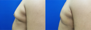 DS-gynecomastia-surgery-nyc-before-after-photo-13-2