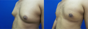 DS-gynecomastia-surgery-nyc-before-after-photo-13-3