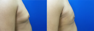 DS-gynecomastia-surgery-nyc-before-after-photo-13-4