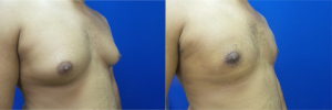 DS-gynecomastia-surgery-nyc-before-after-photo-13-5