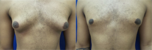 DS-gynecomastia-surgery-nyc-before-after-photo-14-1