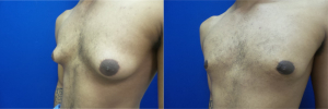 DS-gynecomastia-surgery-nyc-before-after-photo-14-2