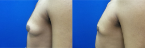 DS-gynecomastia-surgery-nyc-before-after-photo-14-3