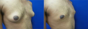 DS-gynecomastia-surgery-nyc-before-after-photo-14-4