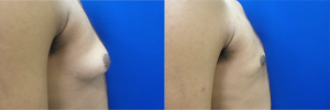 DS-gynecomastia-surgery-nyc-before-after-photo-14-5