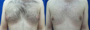 DS-gynecomastia-surgery-nyc-before-after-photo-15-1