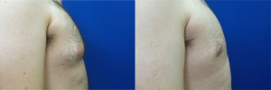 DS-gynecomastia-surgery-nyc-before-after-photo-15-2