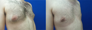 DS-gynecomastia-surgery-nyc-before-after-photo-15-3