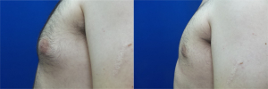 DS-gynecomastia-surgery-nyc-before-after-photo-15-4