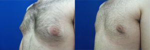 DS-gynecomastia-surgery-nyc-before-after-photo-15-5