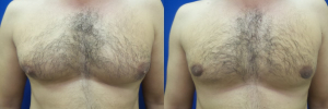 DS-gynecomastia-surgery-nyc-before-after-photo-16-1