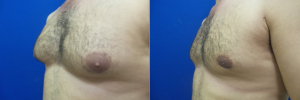 DS-gynecomastia-surgery-nyc-before-after-photo-16-2