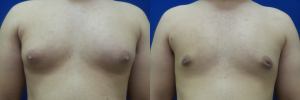 DS-gynecomastia-surgery-nyc-before-after-photo-17-1