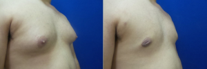 DS-gynecomastia-surgery-nyc-before-after-photo-17-2