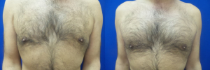 DS-gynecomastia-surgery-nyc-before-after-photo-18-1