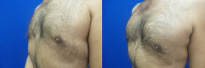 DS-gynecomastia-surgery-nyc-before-after-photo-18-2