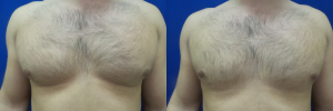 DS-gynecomastia-surgery-nyc-before-after-photo-19-1