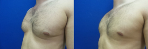 DS-gynecomastia-surgery-nyc-before-after-photo-19-2