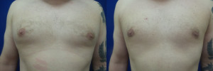 JA-gynecomastia-surgery-nyc-before-after-photo-1-1