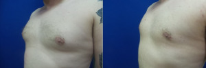 JA-gynecomastia-surgery-nyc-before-after-photo-1-2